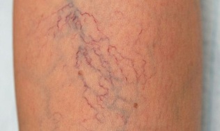 comment traiter les varices chez les femmes